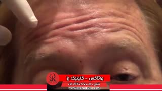 تزریق بوتاکس | فیلم تزریق بوتاکس | کلینیک پوست و مو رز | شماره 33