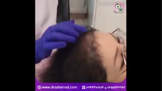 مزوتراپی مو کشیدن دندان
