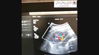 سونوگرافی کالرداپلر عروق کلیه