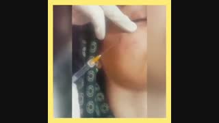 از بین بردن گودی زیر چشم با تزریق ژل