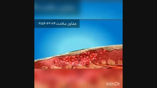 با مشاهده این ویدیو متوجه میشوید لیزر راه درمان زگیل تناسلی نیست