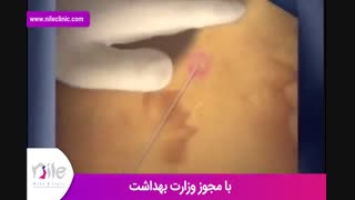 لیپوماتیک | فیلم لیپوماتیک | کلینیک پوست و مو نیل | شماره 26