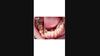 نمونه ارتودنسی | دکتر سیدحامد محمودهاشمی لیزر فرکشنال