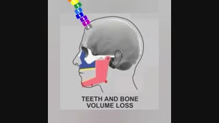 از دست دادن دندان و تحلیل فک