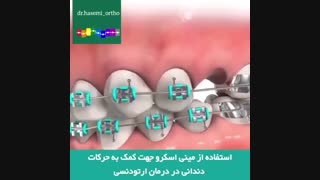 استفاده از مینی اسکرو در ارتودنسی