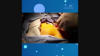 فیلم جراحی میکروسرجری واریکوسل واقعی