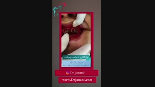 جایگذاری ٨ واحد ایمپلنت در فک بالا