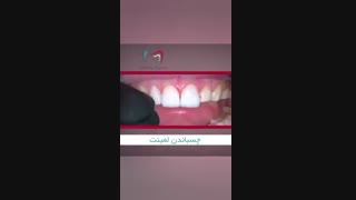 طریقه چسباندن لمینت دندان