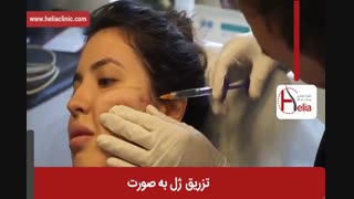 تزریق ژل | فیلم تزریق ژل | کلینیک پوست و مو هلیا | شماره 32