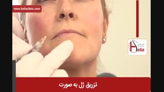 تزریق ژل | فیلم تزریق ژل | کلینیک پوست و مو هلیا | شماره 33