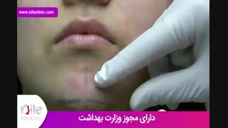 تزریق ژل | فیلم تزریق ژل | کلینیک پوست و مو نیل | شماره 25