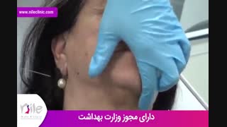 تزریق ژل | فیلم تزریق ژل | کلینیک پوست و مو نیل | شماره 26