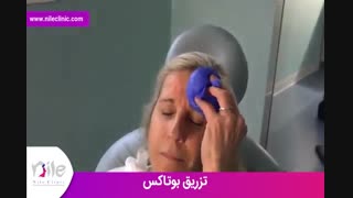 تزریق بوتاکس | فیلم تزریق بوتاکس | کلینیک پوست و مو نیل | شماره 24