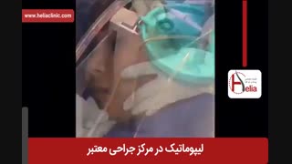 لیپوماتیک | فیلم لیپوماتیک | کلینیک پوست و مو هلیا | شماره 33