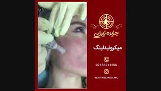 میکرونیدلینگ جای جوش
