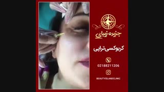 نمونه کار کربوکسی تراپی