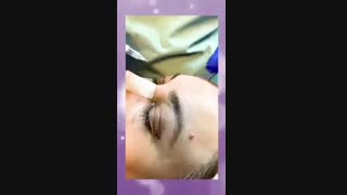 جراحی بلفاروپلاستی ابرسانی پوست
