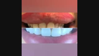 اصلاح طرح لبخند