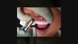 ونیر کامپوزیت