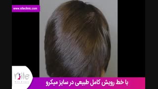 کاشت مو | فیلم کاشت مو | کلینیک پوست و مو نیل | شماره 31