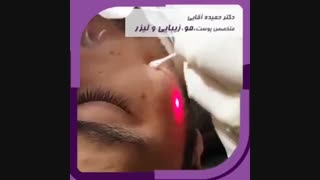 فیلم برداشتنن خال با لیزر دکتر حمیده آقایی متخصص پوست و مو دندانپزشکی کودکان