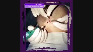بهترین روش کاشت مو ( بدون اسکار و جای زخم) اینسایزینگ