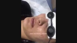 کربوکسی تراپی برداشتن خال گوشتی