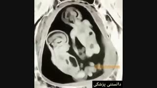 دعوای جنین ها !! چی میکشه مادر :(