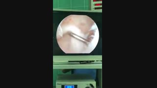 فیلم جراحی رباط صلیبی اطفال