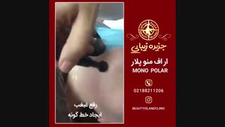 آر اف منوپلار- کلینیک جزیره زیبایی