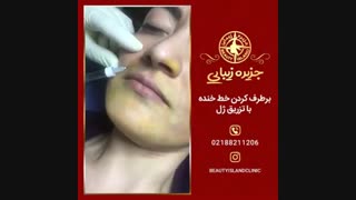 برطرف کردن خط خنده با تزریق ژل