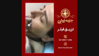تزریق فیلر در کلینیک جزیره زیبائی
