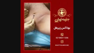 بوتاکس زیر بغل در کلینیکجزیره زیبایی