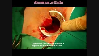 هموروئیدکتومی روشی برای درمان بواسیر یا هموروئید - درمان کلینیک