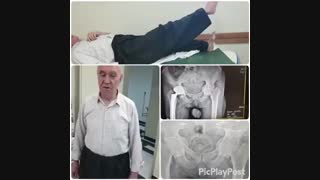 معاینه بیمار 45 روز بعد از جراحی تعویض مفصل لگن سمت راست