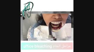 مراحل بلیچینگ دندان