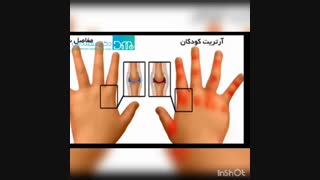 درمان گیاهی آرتروز