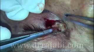 جراحی تومور پلک تحتانی و بازسازی پلک