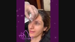 فیلم تزریق  بوتاکس به خط اخم