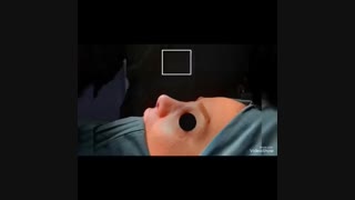 فیلم عمل بینی استخوانی