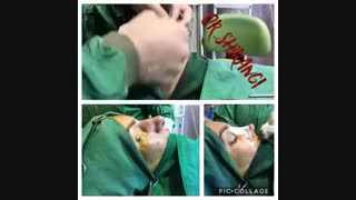 فیلم عمل جراحی زیبایی بینی زنانه