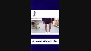 جراحی اصلاح آرتروز زانو و انحراف شدید آن