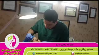 رفع خط بغض با نخ