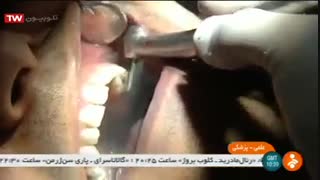 اطلاعاتی در مورد دندان عقل