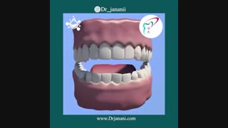 پروتز متکی بر ایمپلنت با اوردنچر