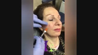 فیلم تزریق فیلر زیر چشم رادیوگرافی دندان
