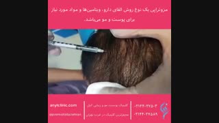 موهایی پرپشت و زیبا با مزوتراپی موی سر