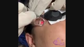 فیلم پاک کردن تاتو پروتز سینه