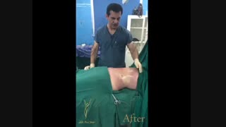 لیپوماتیک شکم پهلو