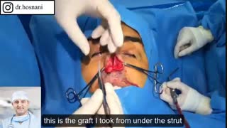 نتایج عالی عمل کودال سپتومی که انحرافش کاملا مشخصه